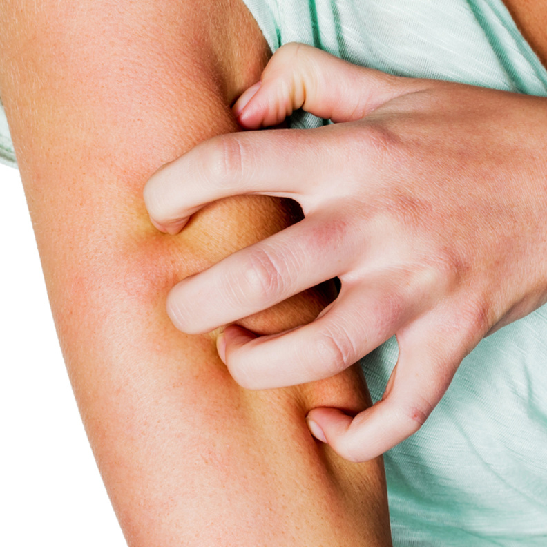 الحكه نتيجه لدغه الباعوض