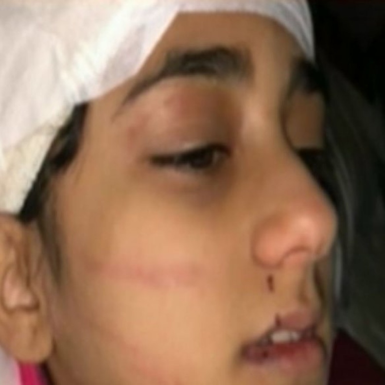 والد مايا بخش يروي تفاصيل إصابة ابنته في مزرعة ذهبان