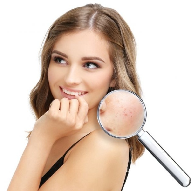 علاج حب الشباب بالأعشاب الخضراء