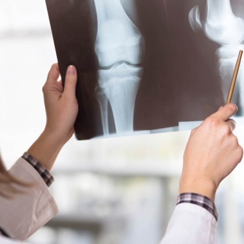 هشاشة العظام