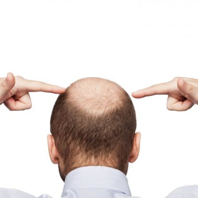 الصلع عند الرجال