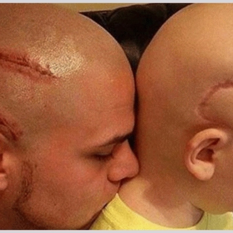 اب يحلق راسه تضامنا مع ابنه مريض السرطان