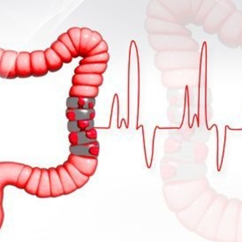 سرطان القولون