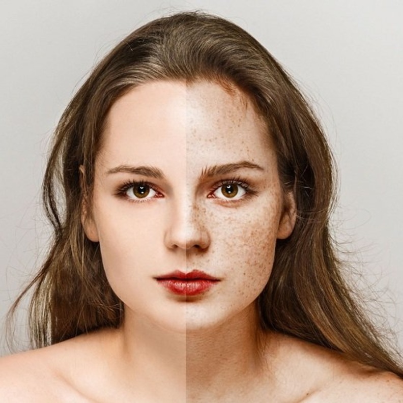 تخلصي من النمش والكلف بالوصفات الطبيعية