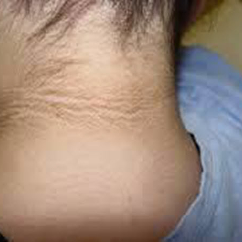 البقع السوداء التي تشير لاحتمال الإصابة بالسكري من النوع الثاني