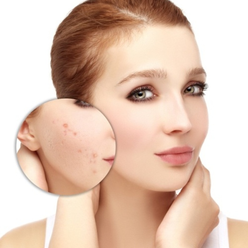 علاج حب الشباب 4