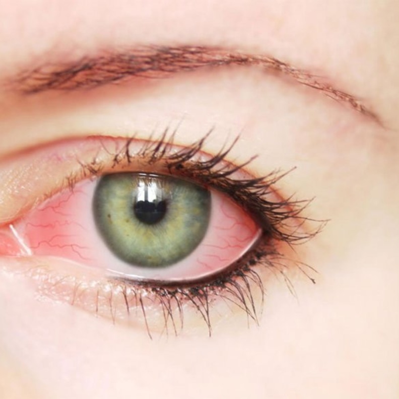 نزيف العين يحدث نتيجة الإصابة بإلتهابات العين.