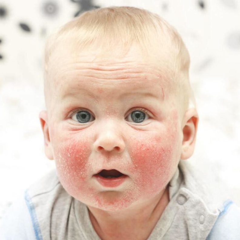 5 امراض جلدية تصيب الاطفال الرضع