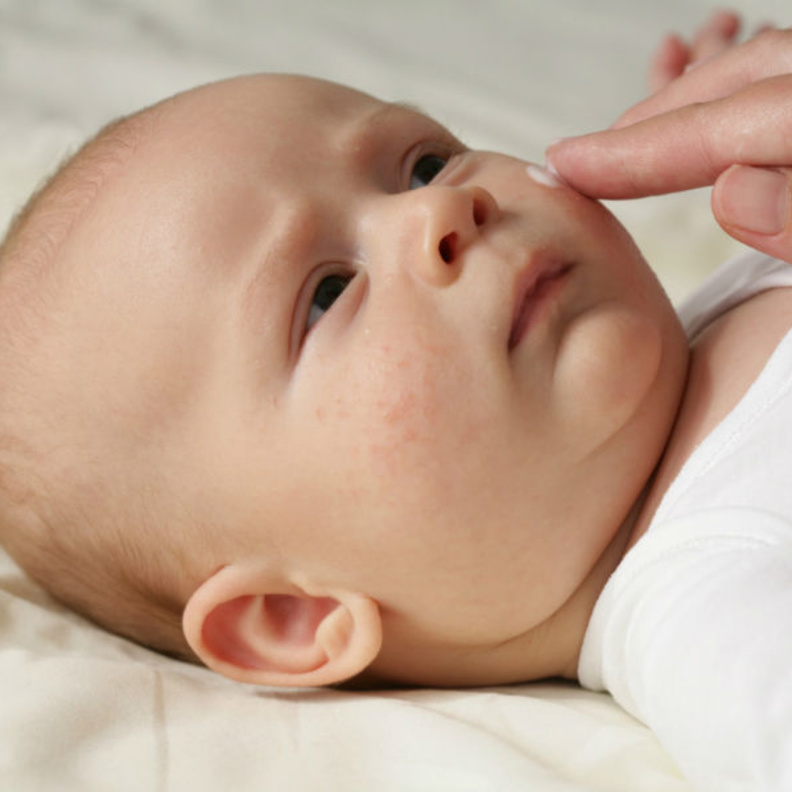 اعراض القوباء الحلقية عند الاطفال