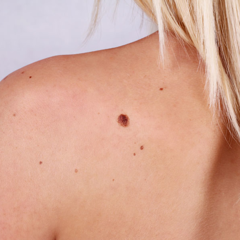 اعراض سرطان الجلد المبكرة