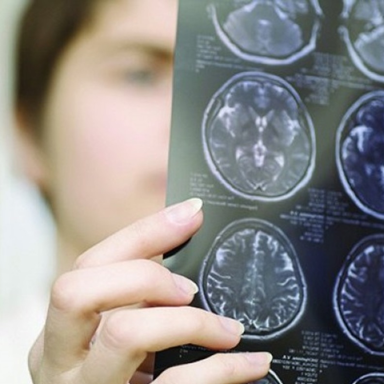  التصلب اللويحي هو التهاب أغشية الدماغ