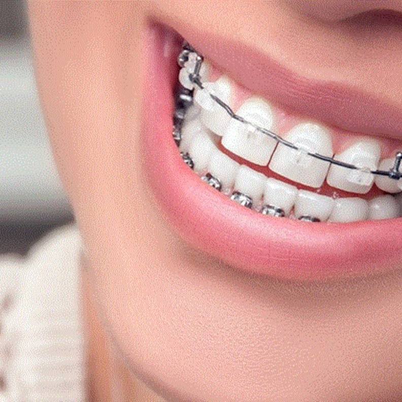 التقويم يعالج بروز الأسنان ويجملها