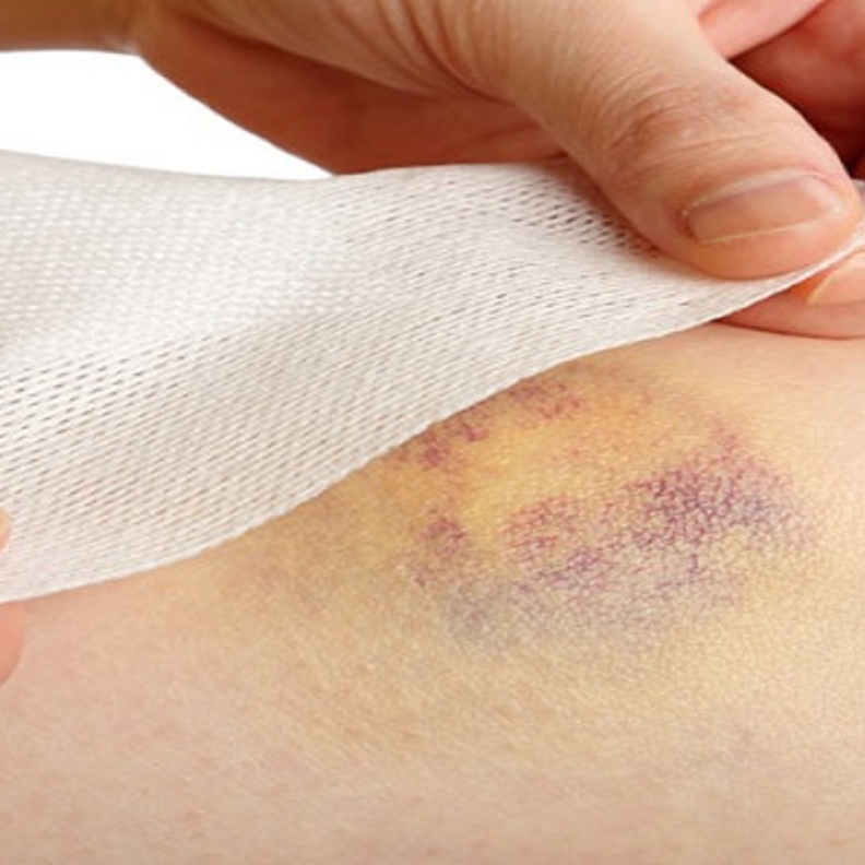 الكدمات يمكن علاجها بكمادات الماء الساخن