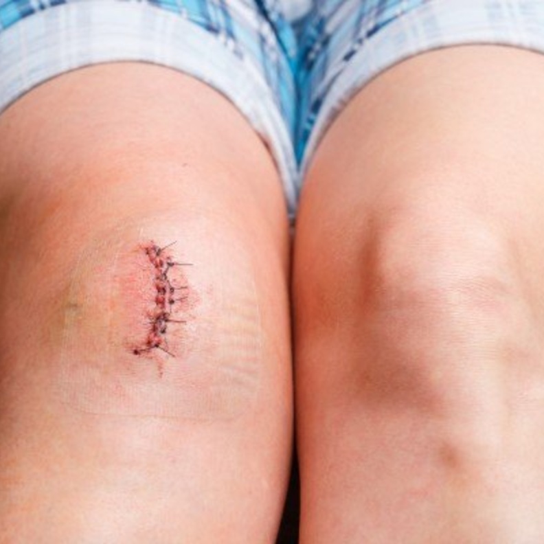 عملية استبدال مفصل الركبة تحتاج إلى تأهيل تدريجي