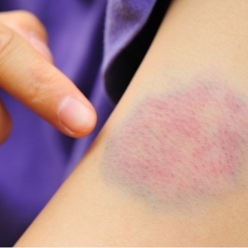 الكدمات من علامات فشل نخاع العظم