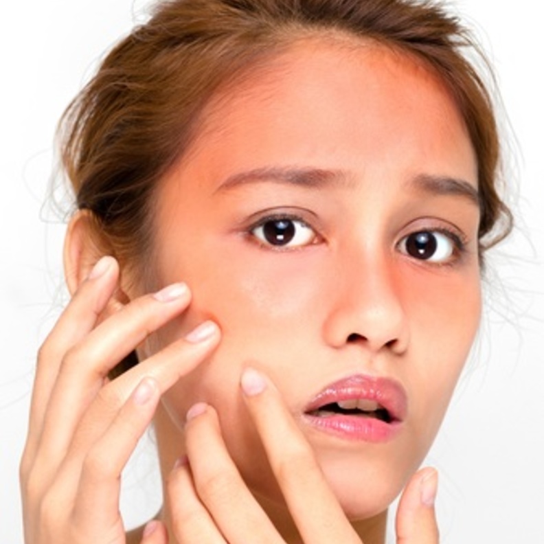 علاج  حروق الشمس