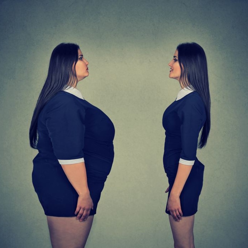 عملية تحوير المعدة تعالج السمنة المفرطة