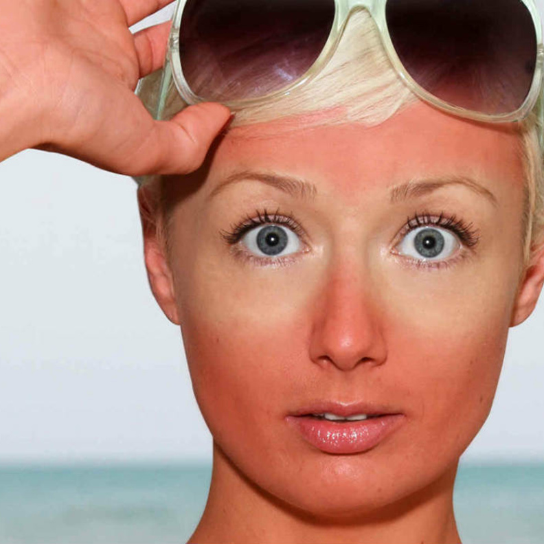 كثرة التعرض للشمس يسبب جفاف وتغير لون البشرة