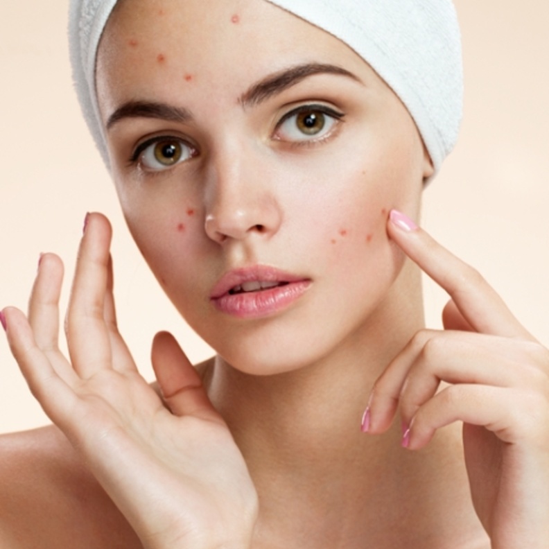 زيت شجرة الشاي يستخدم لعلاج حب الشباب