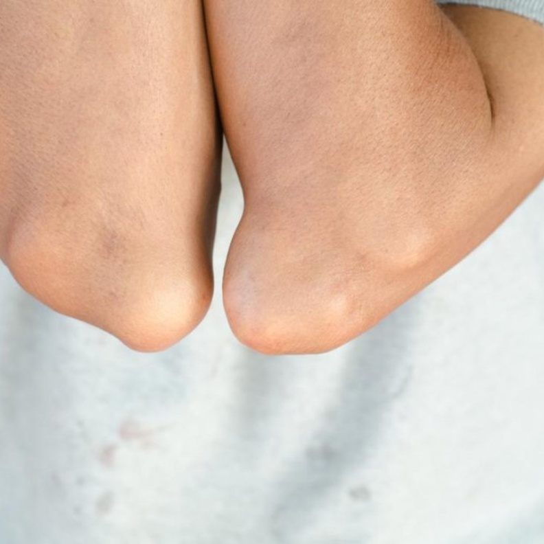 مرض النقرس يسبب آلام وتشوهات في المفاصل و العظام