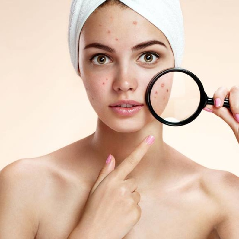 علاج حب الشباب للبشرة الجافة والحساسة