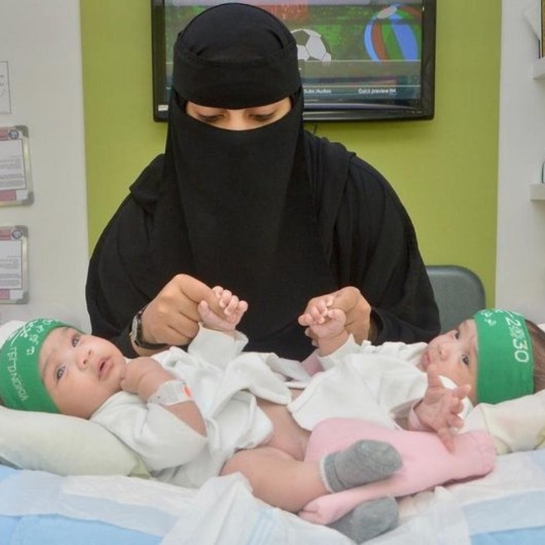 فصل التوأم السيامي السعودي شيخة وشموخ