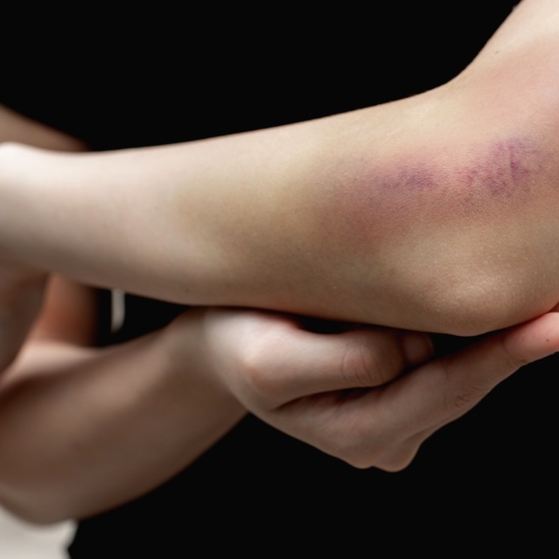  التقدم بالسن يتسبب بظهور كدمات على الجسم