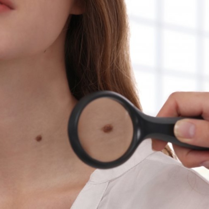 التغير في لون وحجم الشامة من أعراض السرطان