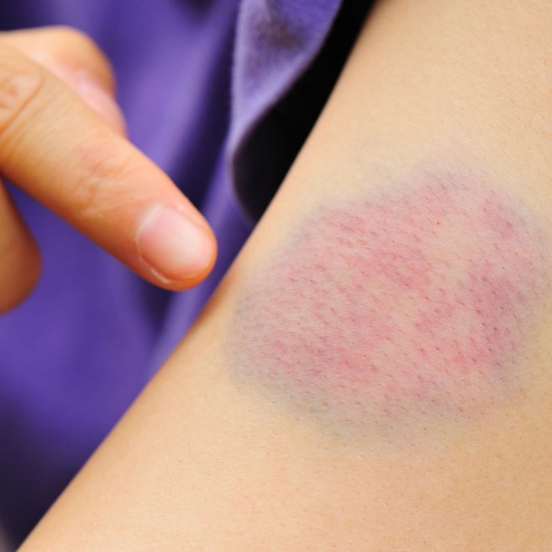 الكدمات من أبرز أعراض الهيموفيليا