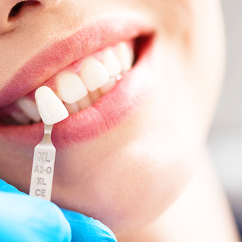 عدسات الأسنان تخفي عيوب الأسنان