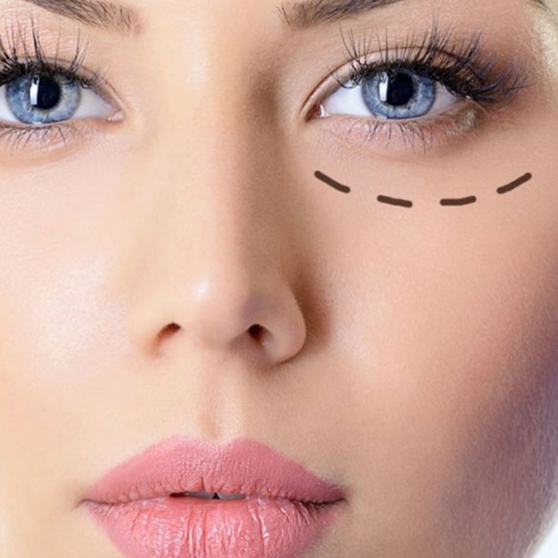 عملية شد الجفون تستمر من خمس إلى سبع سنوات على الأقل