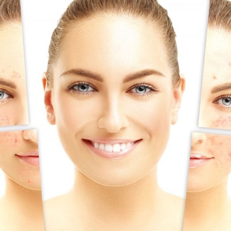 يحارب مشروب زيت الزيتون مع الليمون ظهور حب الشباب والبثور