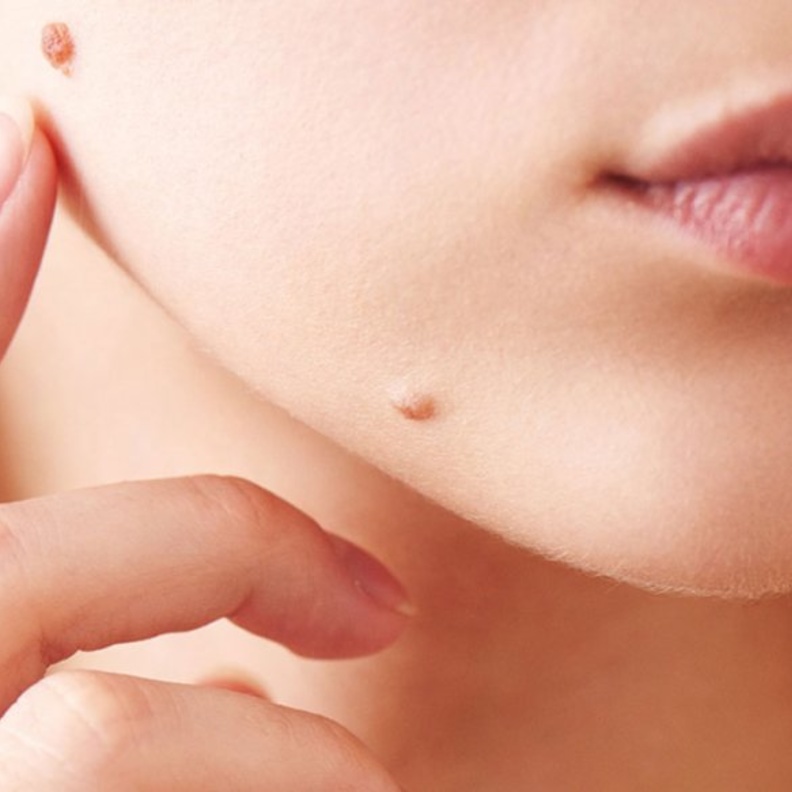 ظهور شامات جديدة غامقة من علامات السرطان