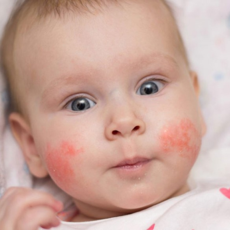  ما هي انواع حساسية الجلد عند الاطفال