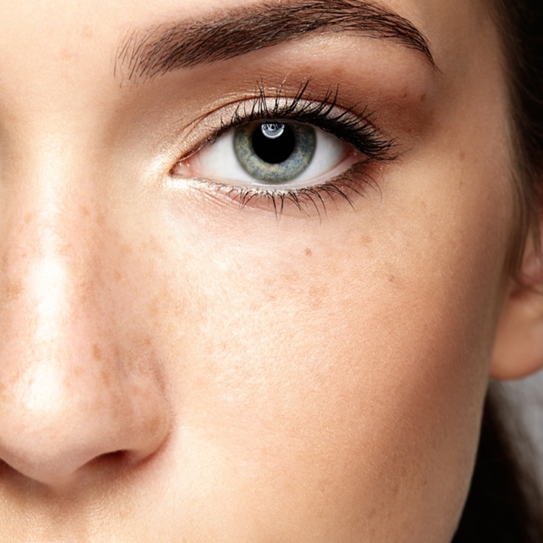 الجراحة الليزرية لإزالة النمش دائمة، لكن هذا لا يعني أن النمش لا يمكن أن تعود للظهور مرة أخرى