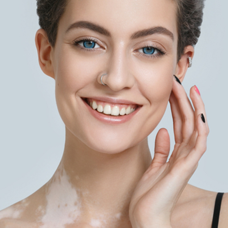  مرض المهق يسبب تغير في لون الجلد