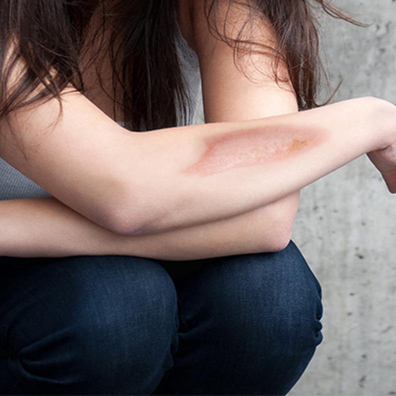 الليزر تقنية مهمة وفعّالة لإزالة الحروق عن الجسم