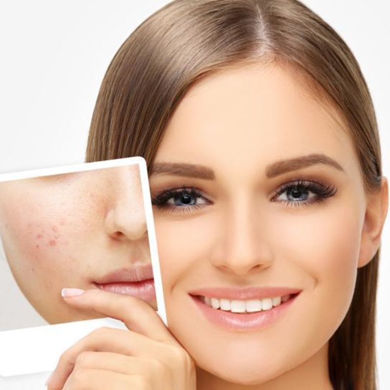 اخفاء حبوب الوجه بالمكياج