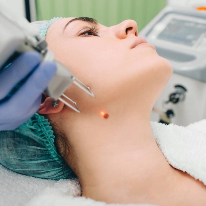  الليزر سيساعدك على التخلص من أي شامة في جسمك بطريقة سهلة وسريعة