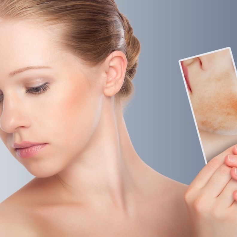 اعراض الذئبة الحمراء المبكرة و طرق علاجها