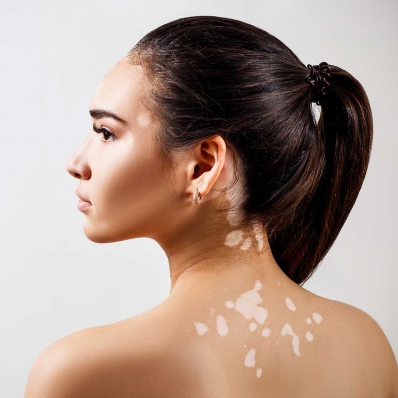 البهاق هو حالة جلدية مزمنة تؤدي إلى تلف مناطق الجلد