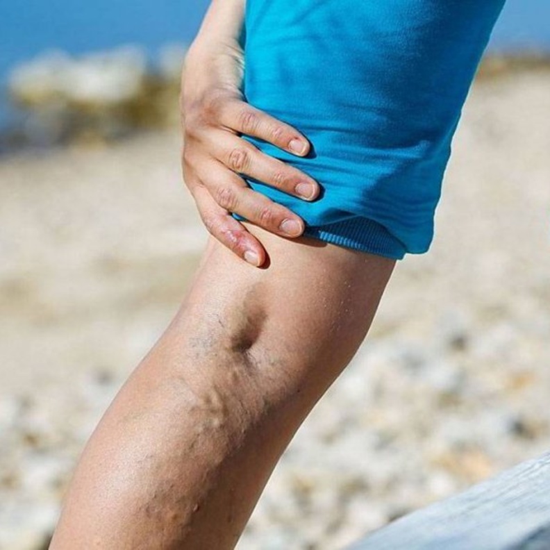  دوالي الساقين يمكن أن تسبب جلطات في الدم