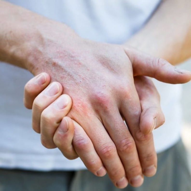  البهاق مرض جلدي يصعب الوقاية منه