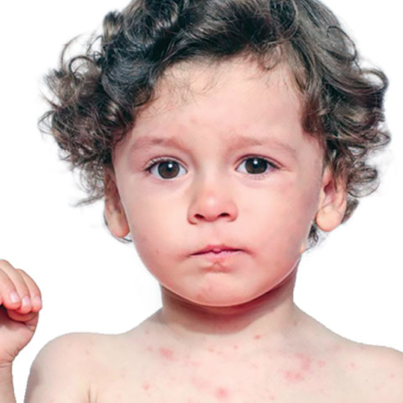 أهم اعراض الجدري المائي عند الاطفال ومخاطره