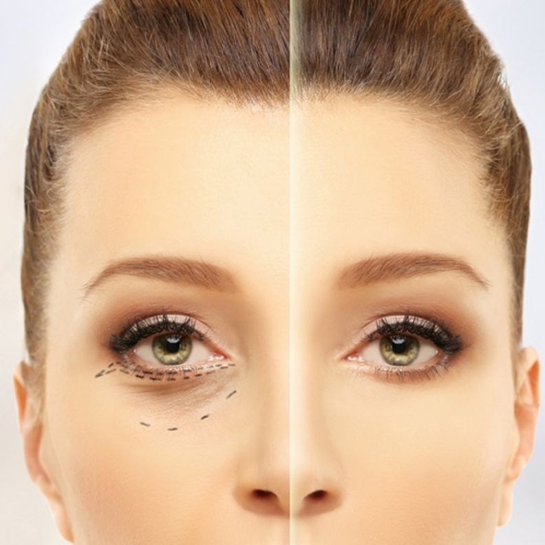  فوائد حقن الهيالورنيك للهالات السوداء