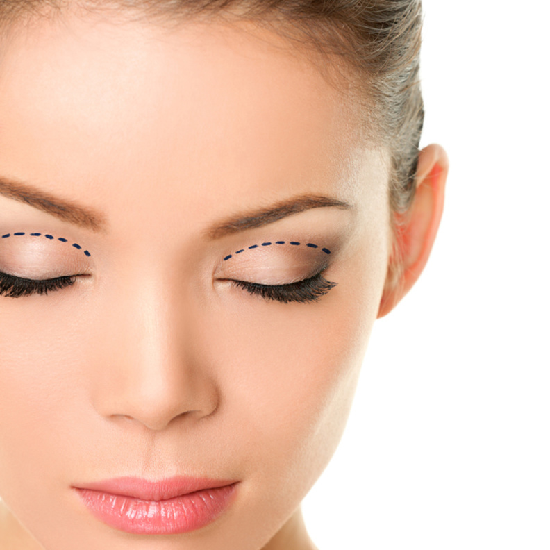 الجفن المزدوج