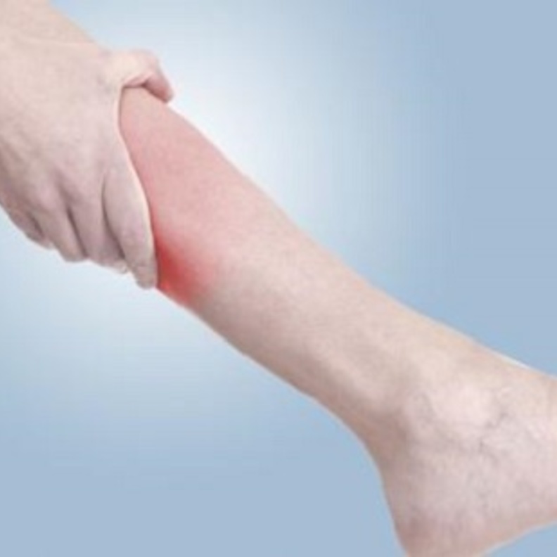 الدوالي عند النساء