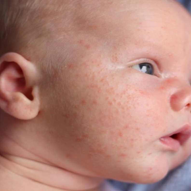 حبوب الوجه لدي الرضع