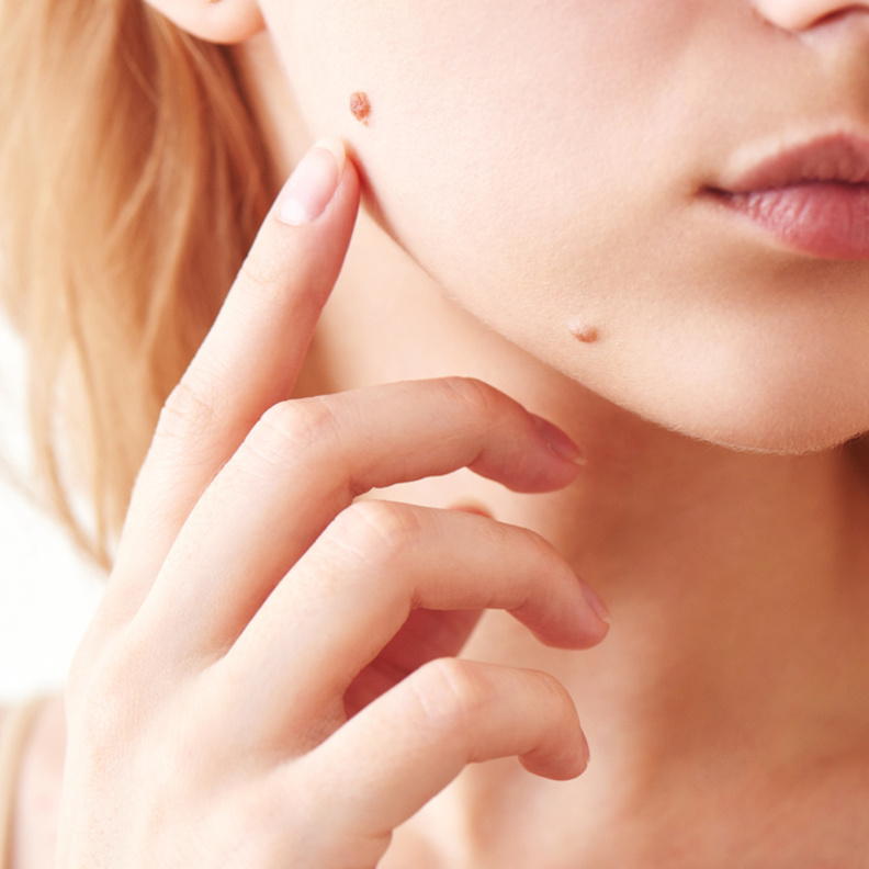 ازالة الشامة