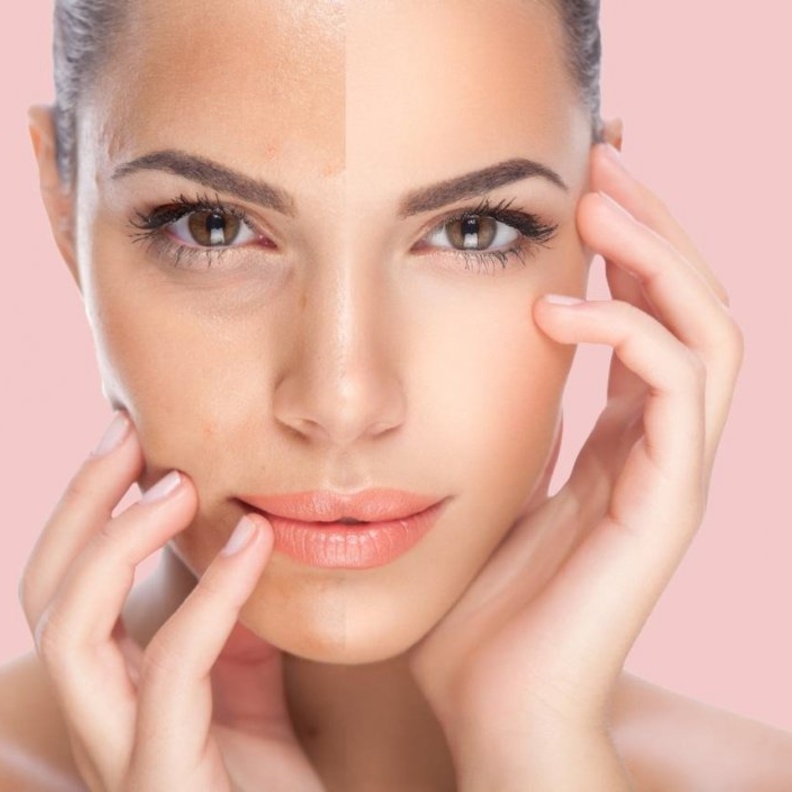 اضرار وفوائد تبييض البشرة بالليزر